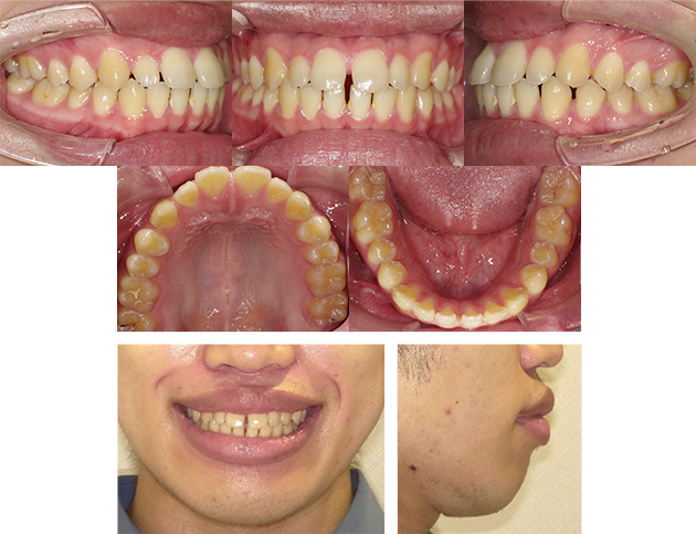 空隙歯列Before