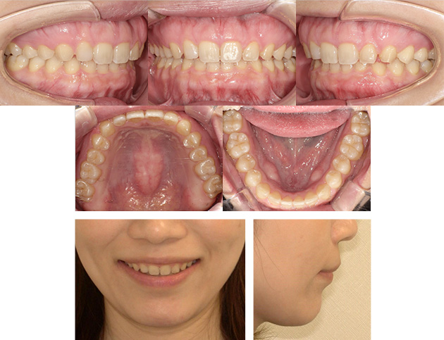 空隙歯列After