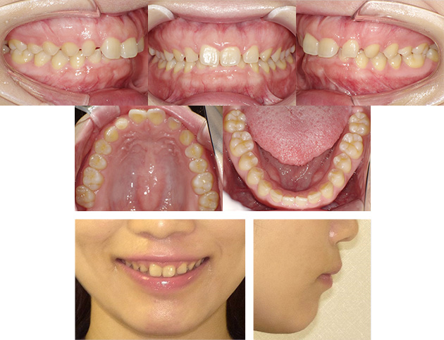 空隙歯列Before