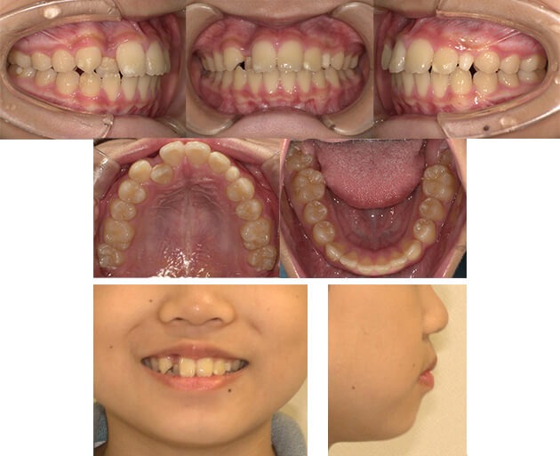叢生症例17 before