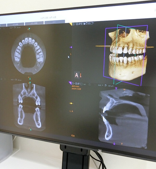 【歯科用CT】による立体的で精密な3次元診断