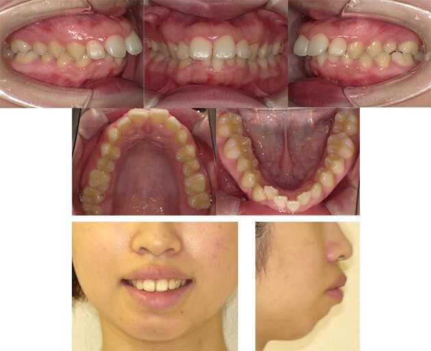 上顎前突症例09 before