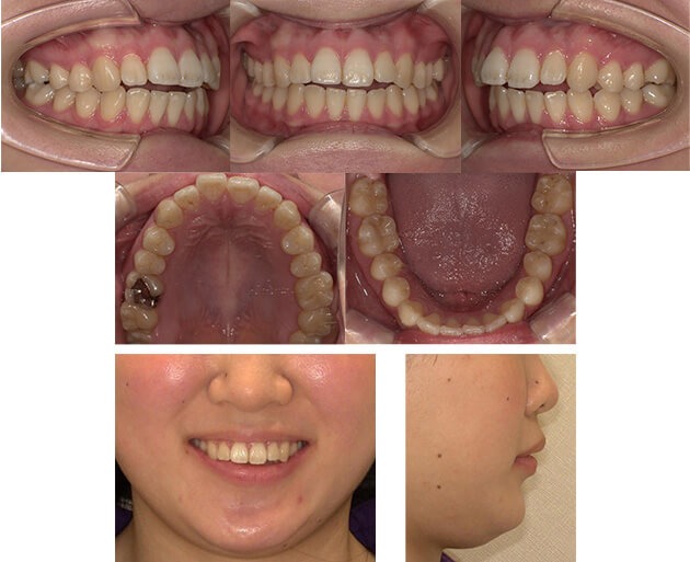 上顎前突症例10 before